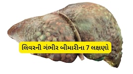 શરીરના આ મહત્ત્વના અંગને ન કરો નજરઅંદાજ; જાણો લિવર સિરોસિસના શરૂઆતી સંકેતો અને બચાવના ઉપાય