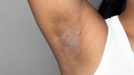 Dark Underarms: ડાર્ક અંડરઆર્મ્સથી નવરાત્રી પહેલા છુટકારો મેળવવા અપનાવો આ અચૂક ઉપાય, 2 દિવસમાં ડાર્ક સ્કિન નોર્મલ થઈ જશે