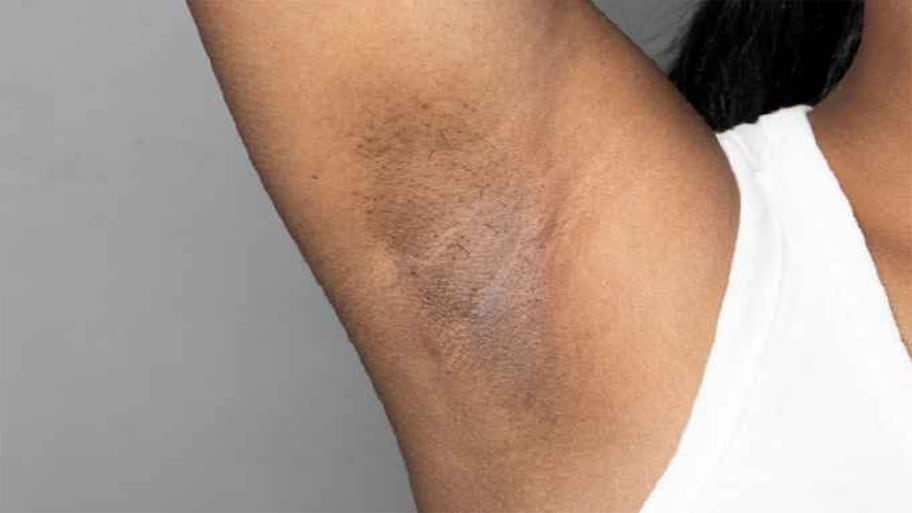 Dark Underarms: ડાર્ક અંડરઆર્મ્સથી નવરાત્રી પહેલા છુટકારો મેળવવા અપનાવો આ અચૂક ઉપાય, 2 દિવસમાં ડાર્ક સ્કિન નોર્મલ થઈ જશે
