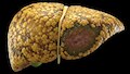 Fatty Liver: ડોક્ટરે જણાવ્યો ફેટી લીવર રિવર્સ કરવાનો ઉપાય, 5 દેશી પીણા ફેટી લીવરના પેશન્ટ માટે ફાયદાકારક