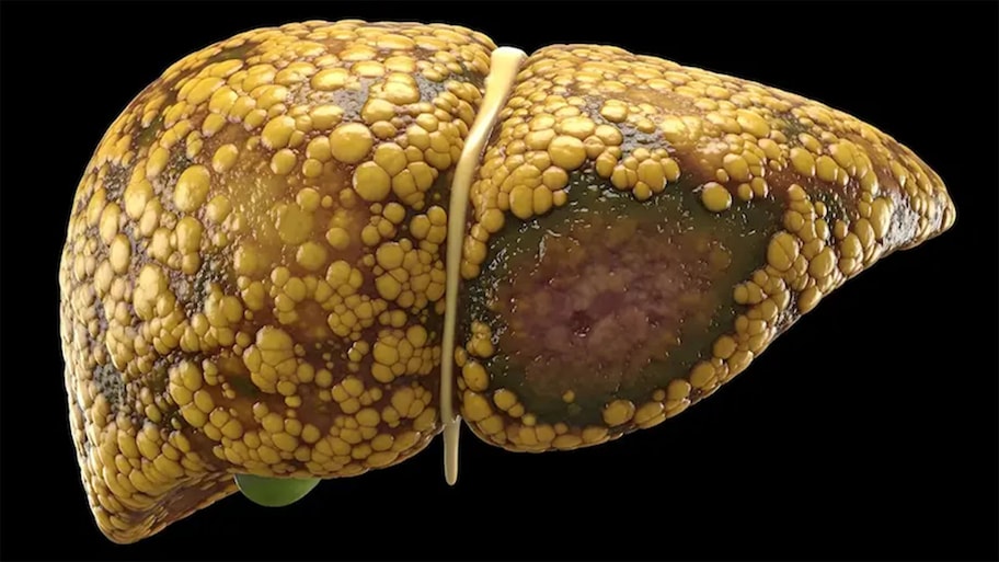 Fatty Liver: ડોક્ટરે જણાવ્યો ફેટી લીવર રિવર્સ કરવાનો ઉપાય, 5 દેશી પીણા ફેટી લીવરના પેશન્ટ માટે ફાયદાકારક