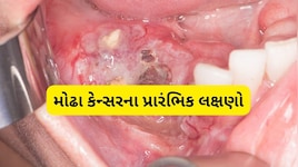 દાંતમાં દેખાતા આ લક્ષણ હોઈ શકે છે કેન્સરનો સંકેત, ન કરો નજરઅંદાજ