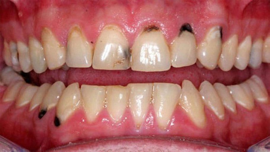 Teeth Cleaning: દાંત પર કાળા ડાઘ પડી ગયા છે? આ વસ્તુથી દાંત સાફ કરજો, ડાઘ થઈ જશે સાફ