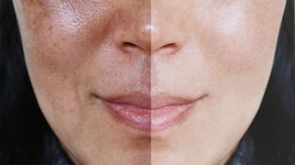 Skin Pigmentation: આ વિટામિનની ખામીના કારણે ચહેરા પર બદામી રંગના ડાઘ, જાણો કઈ વસ્તુઓ ખાવાથી સ્કિન ક્લિયર થઈ જાય