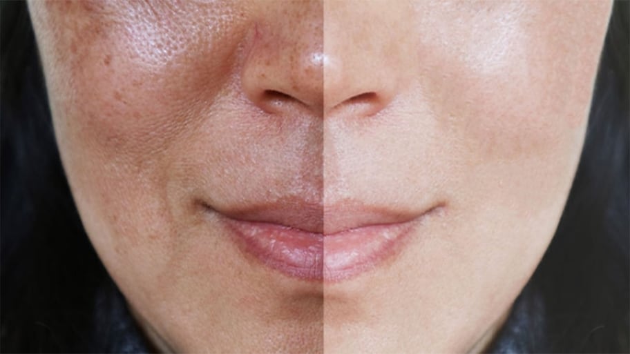 Skin Pigmentation: આ વિટામિનની ખામીના કારણે ચહેરા પર બદામી રંગના ડાઘ, જાણો કઈ વસ્તુઓ ખાવાથી સ્કિન ક્લિયર થઈ જાય