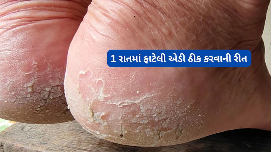 Crack Heel Remedy: ફટાફટ મટવા લાગશે એડીમાં પડેલા ચીરા, આ ઘરેલુ ઈલાજ છે પગના વાઢિયાનો રામબાણ ઈલાજ