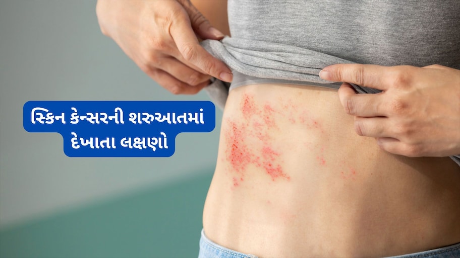 Skin Cancer: ચામડીમાં થતા આ ફેરફારને સામાન્ય ન સમજો, ખાસ તો લાલ નિશાન દેખાય તો તુરંત પહોંચો ડોક્ટર પાસે